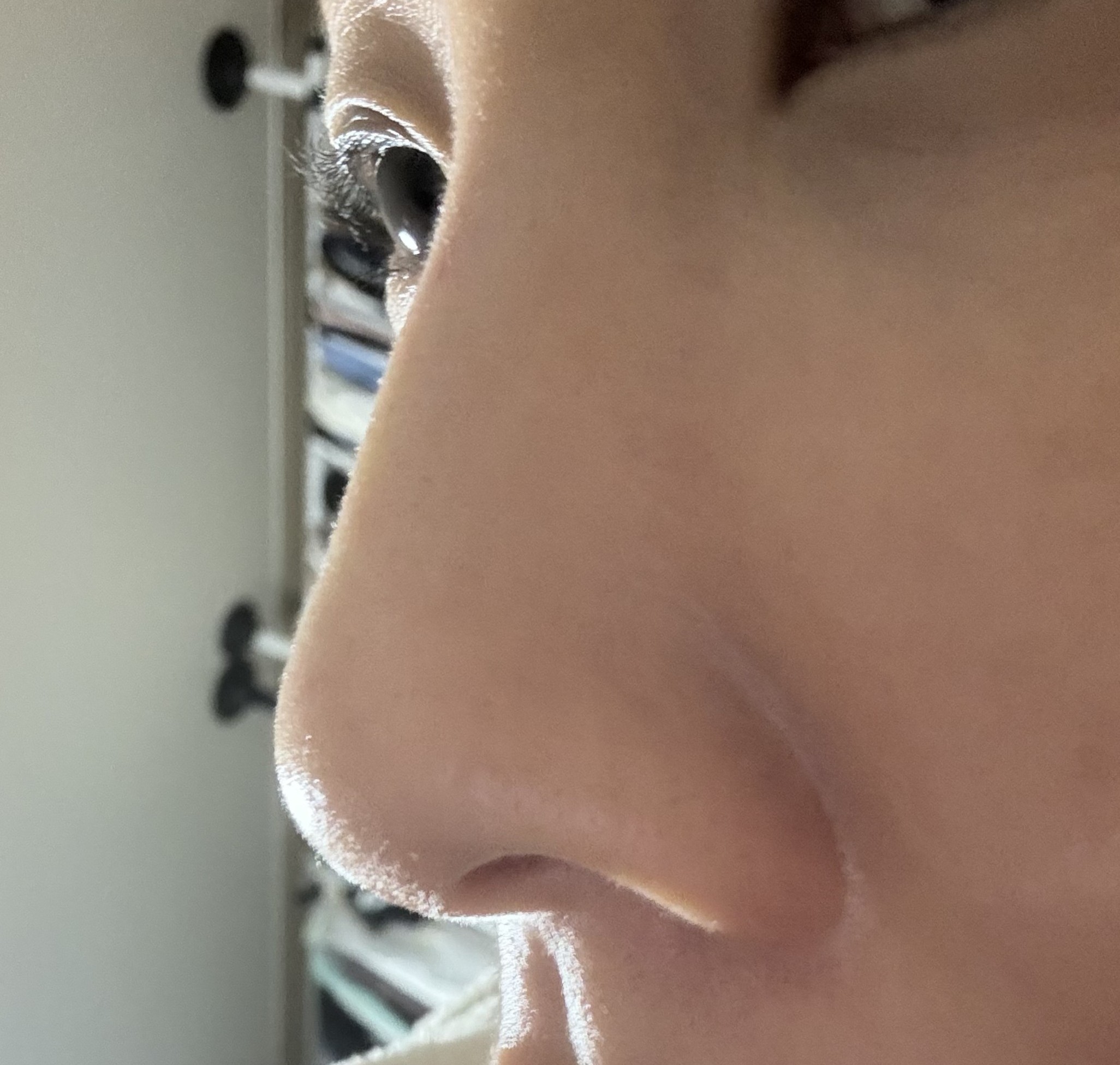 메부리 교정 코필러+하이코 시술했어요!