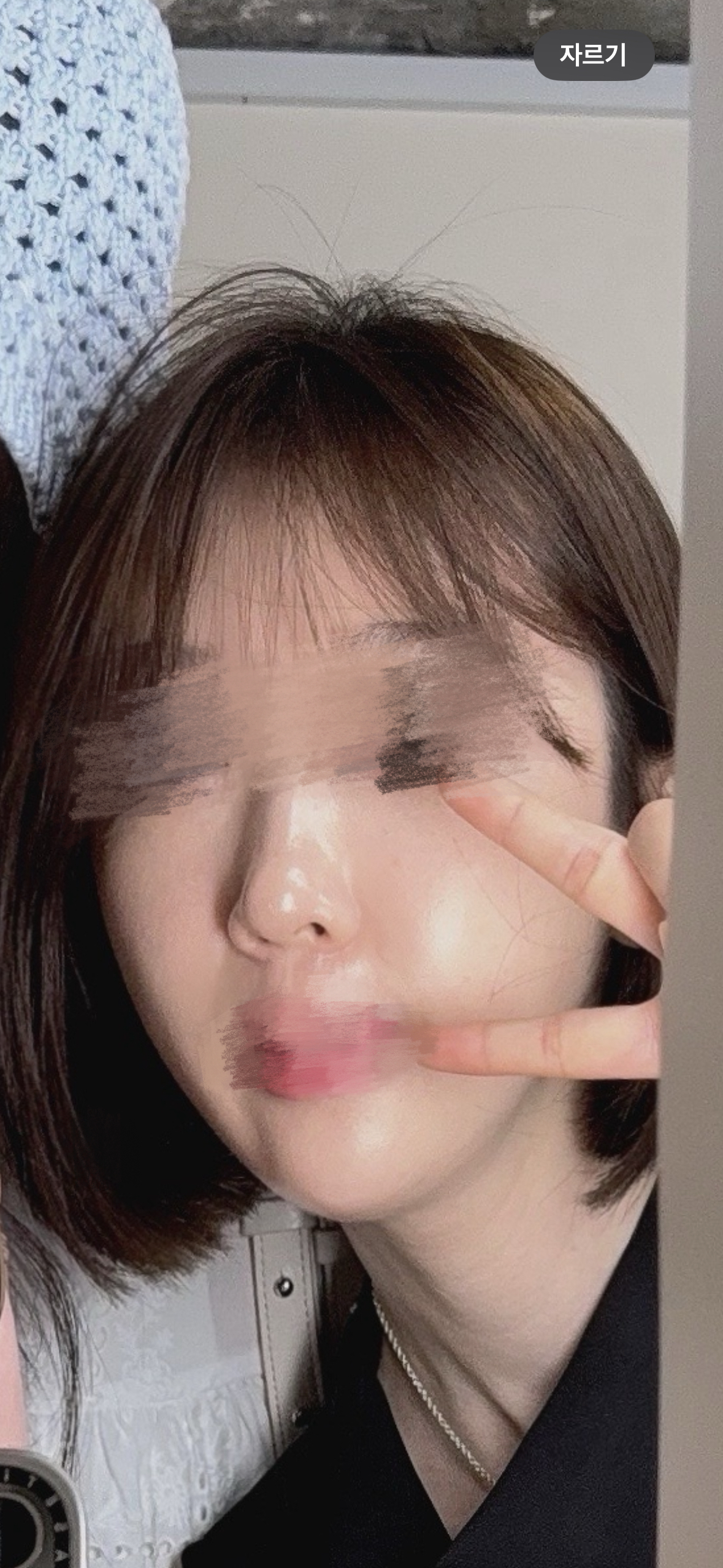 팔자 잼버실 + 턱필러 라인시술