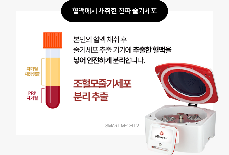 혈액에서 채취한 진짜 줄기세포 본인의 혈액 채취 후 줄기세포 추출 기기에 추출한 열액을 넣어 안전하게 분리합니다. 조혈모줄기세포 분리추출