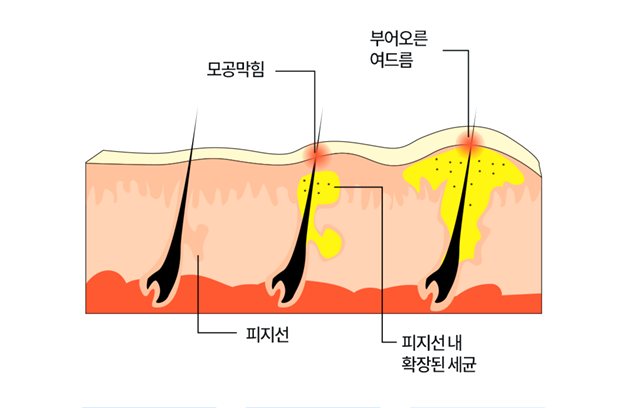 모공막힘, 부어오른 여드름, 피지선, 피지선 내 확장된 세균 이미지