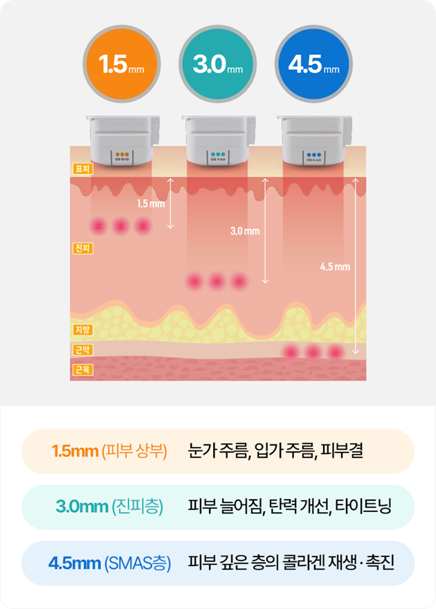  1.5mm(피부 상부) - 눈가 주름, 입가 주름, 피부결   3.0mm(진피층) - 피부 늘어짐, 탄력 개선, 타이트닝   4.5mm(SMAS층) - 피부 깊은 층의 콜라겐 재생/촉진