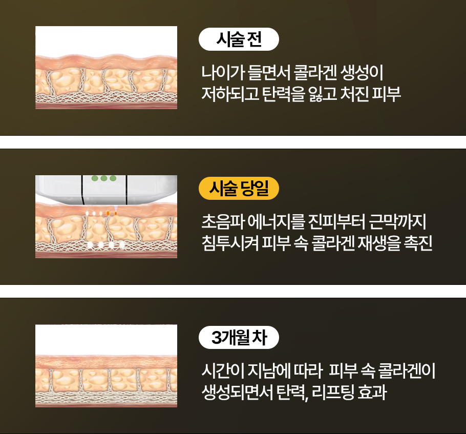 시술 전 - 나이가 들면서 콜라겐 생성이 저하되고 탄력을 잃고 처진 피부   시술 당일 - 초음파 에너지를 진피부터 근막까지 침투시켜 피부 속 콜라겐 재생을 촉진   3개월 차 - 시간이 지남에 따라 피부 속 콜라겐이 생성되면서 탄력, 리프팅 효과