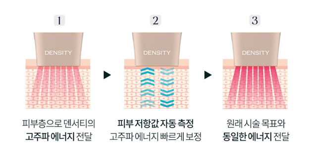 1. 피부층으로 덴서티의 고주파 에너지 전달  2. 피부 저항값 자동 측정 고주파 에너지 빠르게 보정  3. 원래 시술 목표와 동일한 에너지 전달